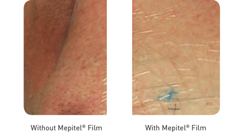 With and without Mepitel Film