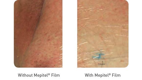 With and without Mepitel Film